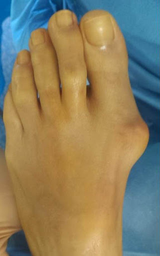 Hallux valgus